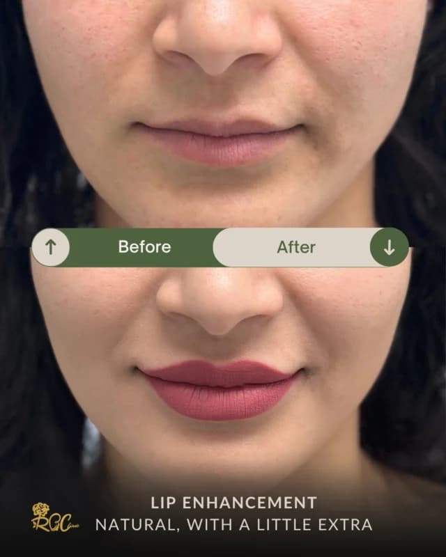 Lip enhancement: clinic-published before and after photographs