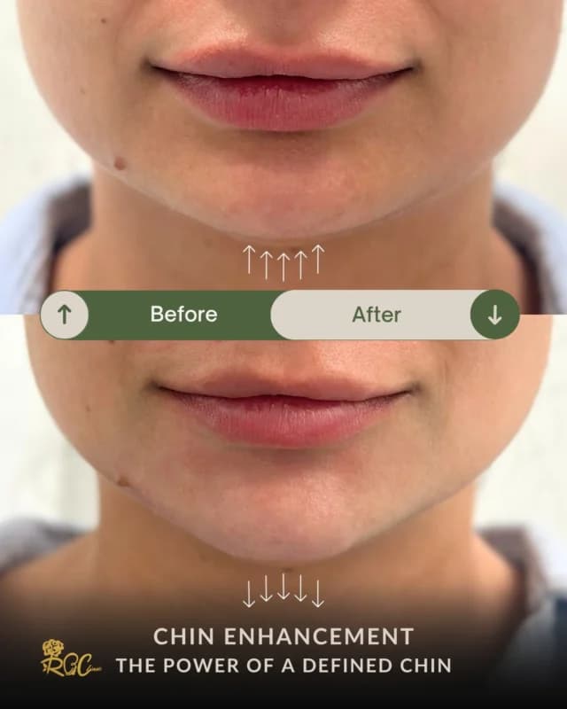 Chin enhancement: clinic-published before and after photographs