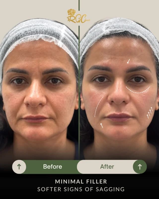 Facial support with filler: clinic-published before and after photographs